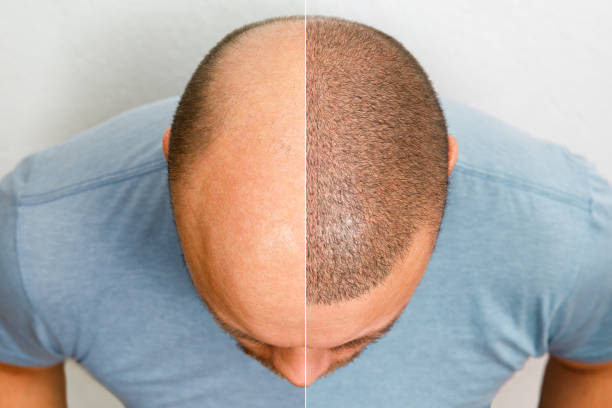 hair transplant costs in Abu Dhabi