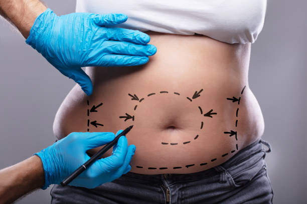 liposuction in Abu Dhabi