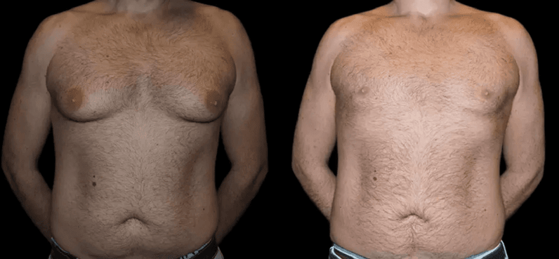 male breast reduction