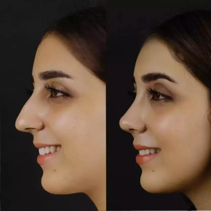 Rhinoplasty in Dubai: Restoring Your Broken Nose