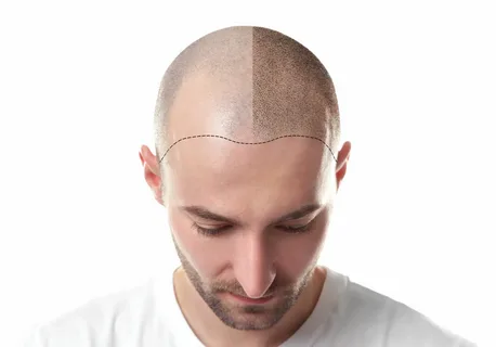 Hair transplantation in Abu Dhabi