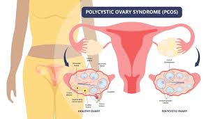 pcos homeopathy treatment