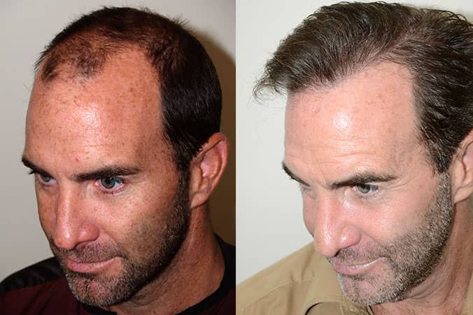 Hair Transplant Cost: What You Need to Budget For