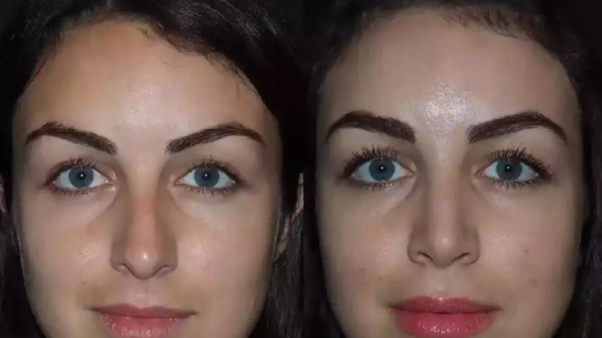 How Long Does Bruising Last After Rhinoplasty?