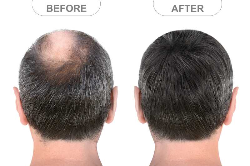 Hair Transplant Clinic