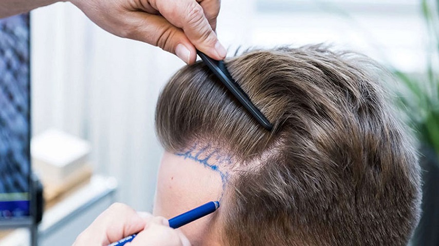 hair transplant cost