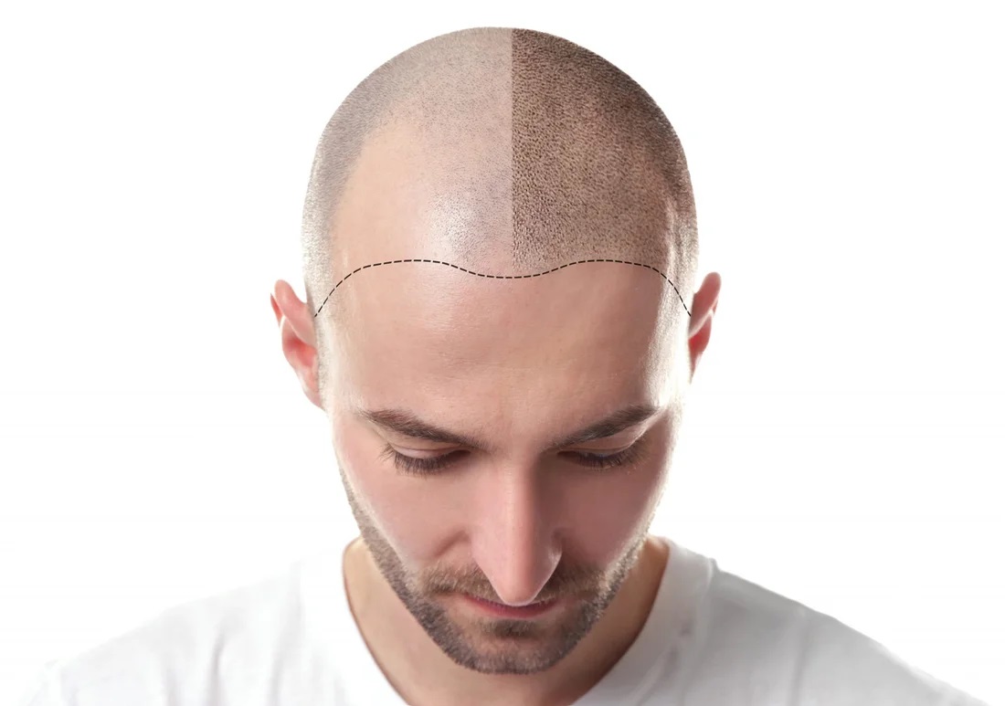 hair transplant