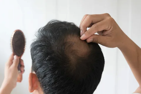 Hair transplantation in Abu Dhabi