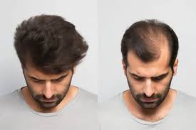 Hair Transplant in Riyadh