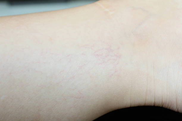 How Long Does Spider Veins Treatment Take to Show Results?