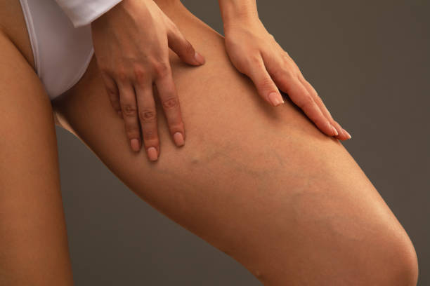 How Long Does Spider Veins Treatment Take to Show Results?