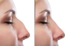 Rhinoplasty Surgery in Dubai