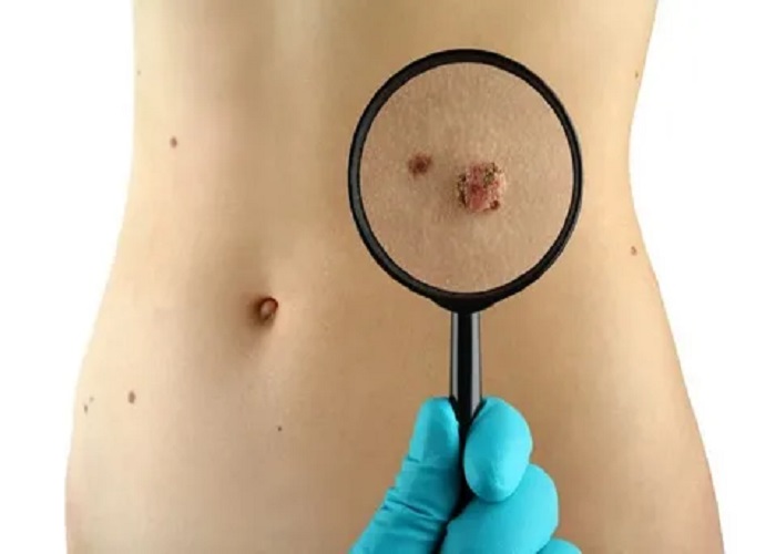 Birthmark Removal in Riyadh