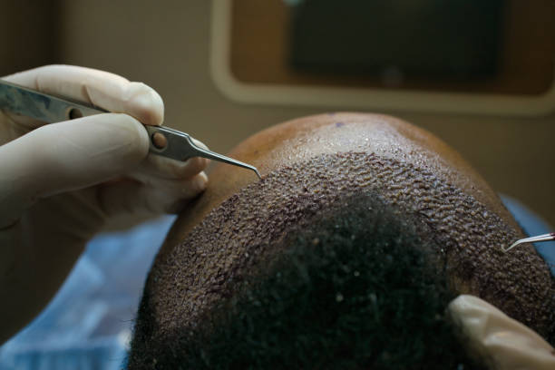 10 Reasons to Choose for Your Hair Transplant Journey