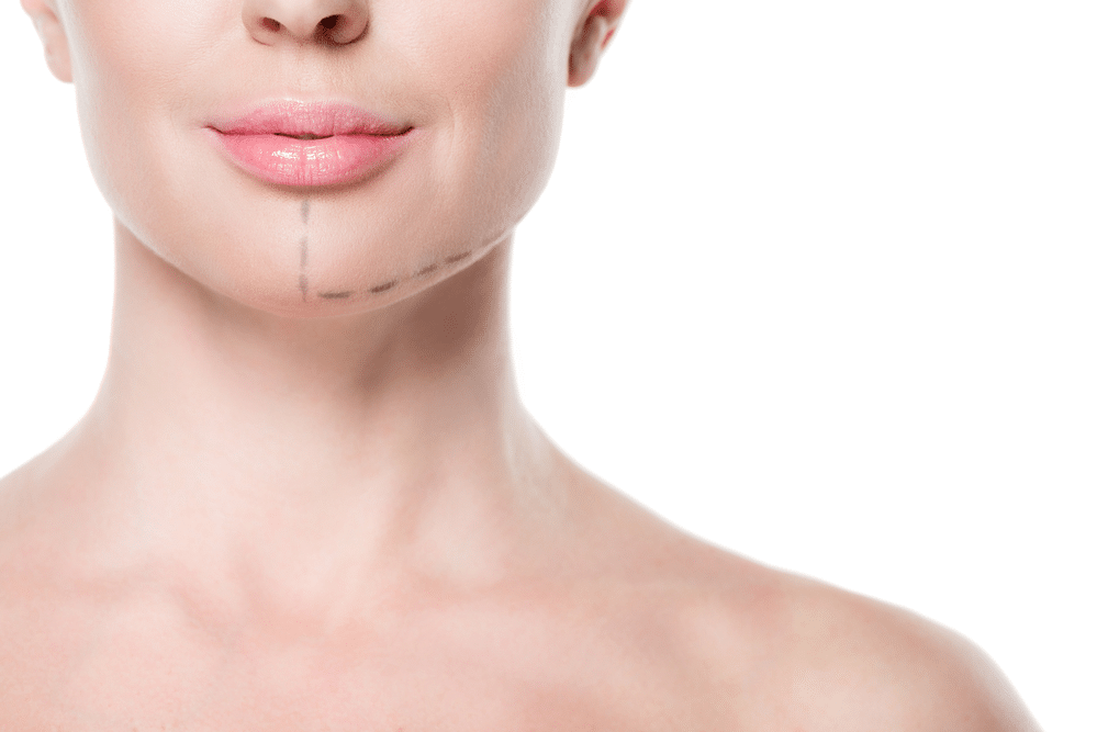 Understanding the Facelift Procedure: Insights from Experts