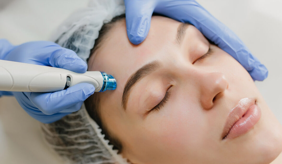 Discover Clearer Skin with Microneedling for Acne Scars