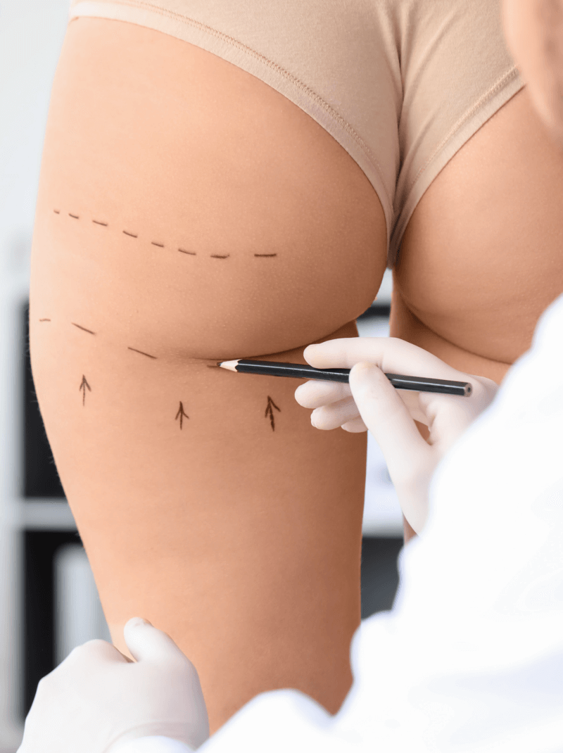 Discovering the Wonders of Body Fillers: Butt Fillers