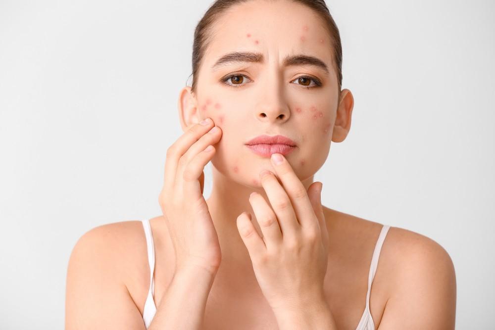 Get Rid of Acne with Advanced Treatments 