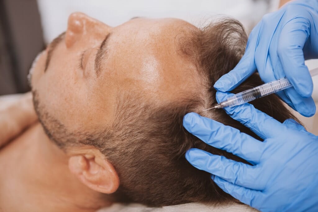 How to Prepare for a Hair Transplant