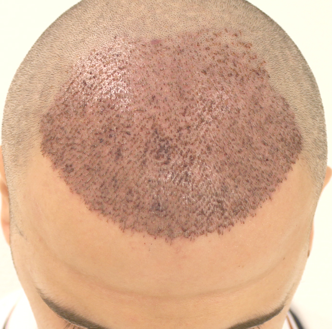 Is a Hair Transplant Painful During and After Surgery?