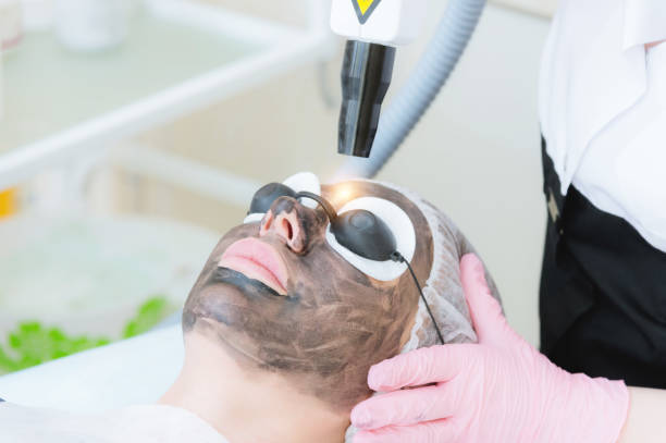 Laser Carbon Peel A Game Changer for Skin Care