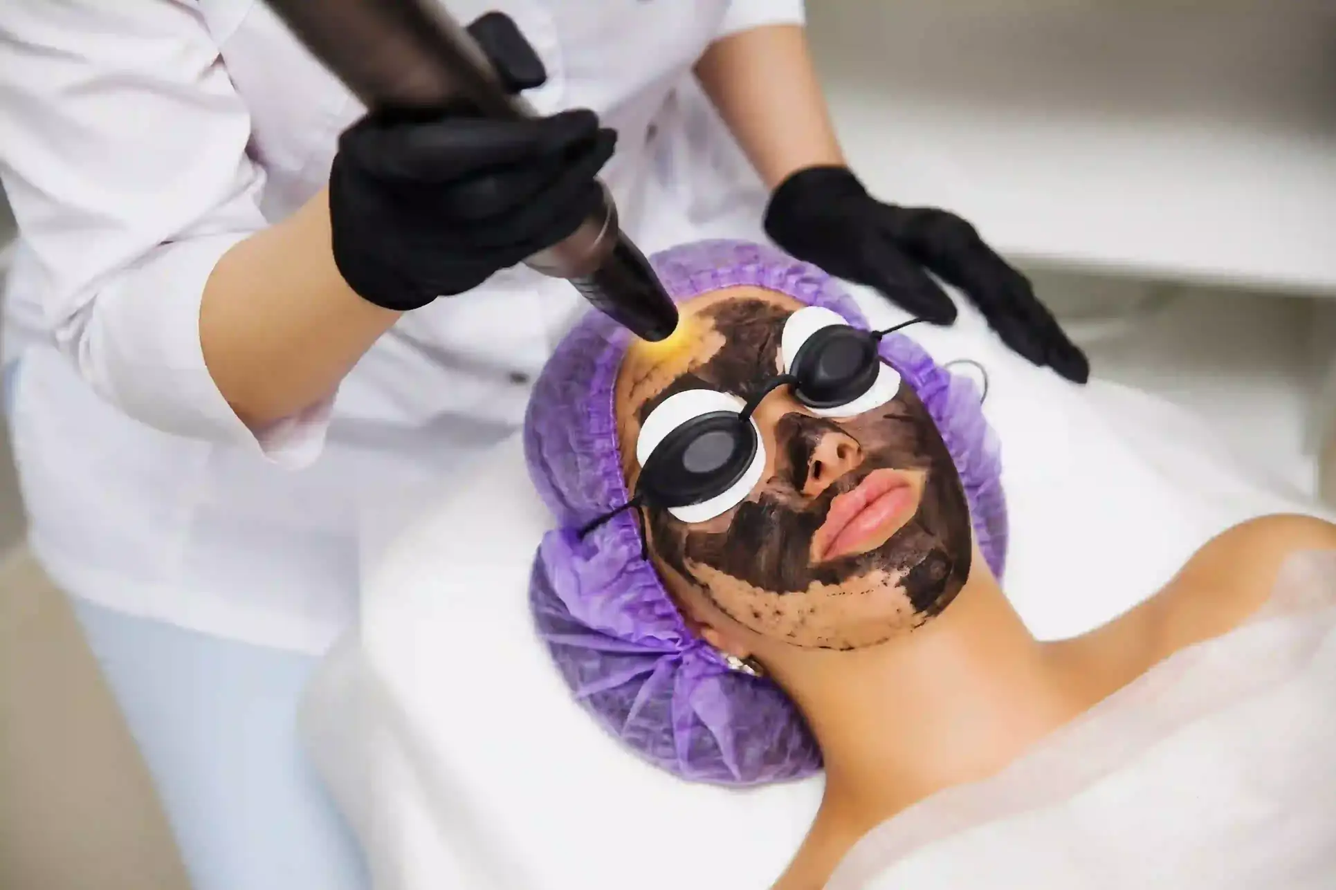 Laser Carbon Peel A Game Changer for Skin Care