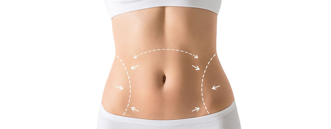 Long-Term Results of Circumferential Abdominoplasty