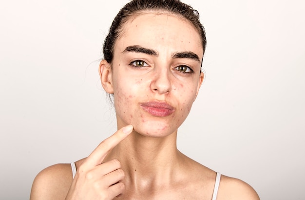 Get Rid of Acne with Advanced Treatments