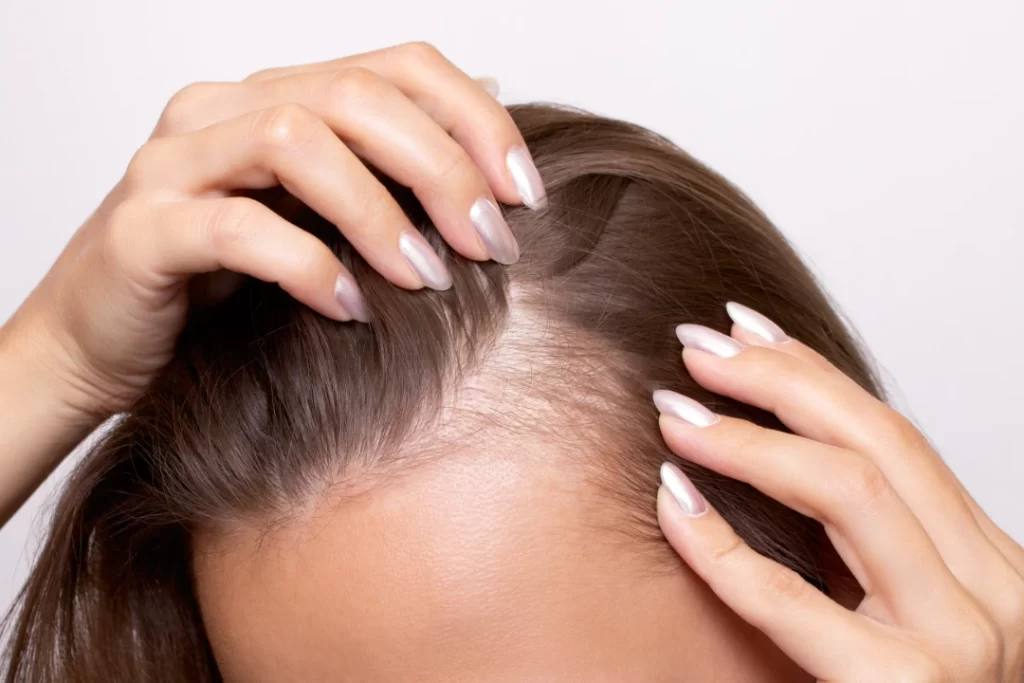 Can Hair Transplant Fix Thinning Hair for Women