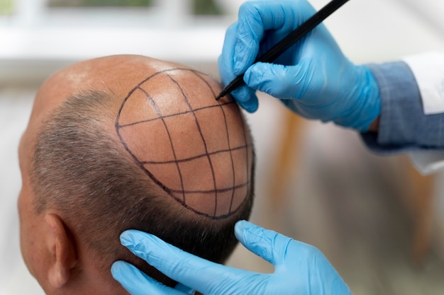 Custom Hairline Design for Crown Transplants
