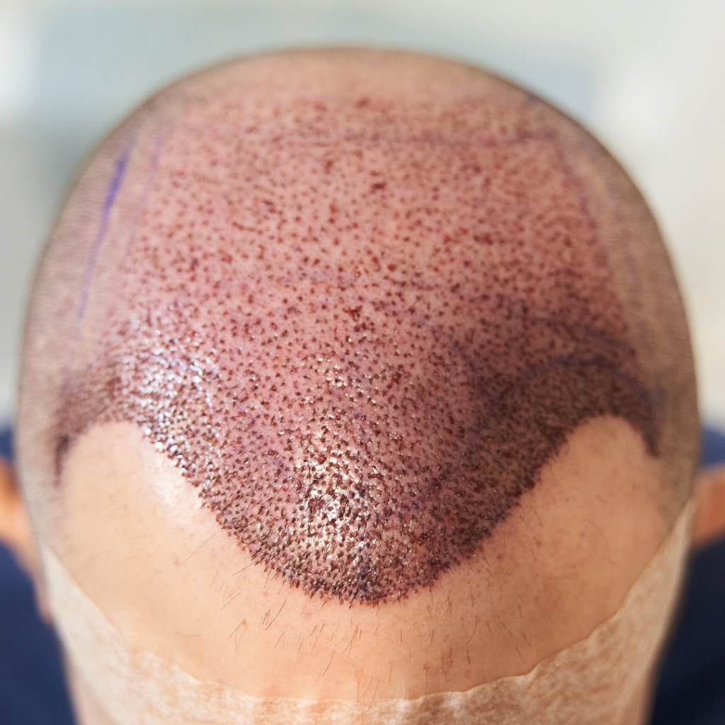 Custom Hairline Design for Crown Transplants