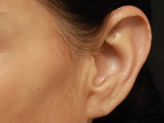 Effective Solutions for Split Earlobe Surgery