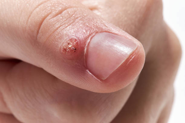 Effective Techniques for Warts Removal Treatment