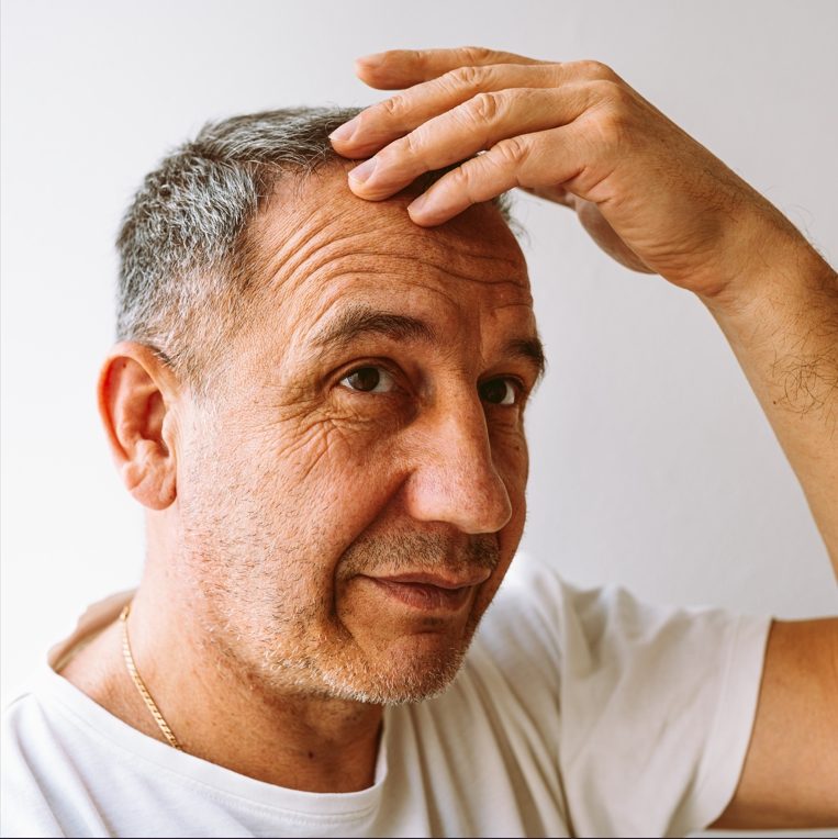 How Soon Will You See Results After a Hair Transplant in Dubai?