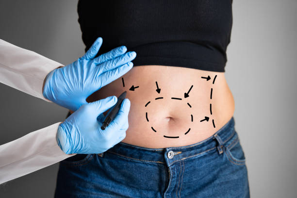 Innovative Mini Abdominoplasty Methods      