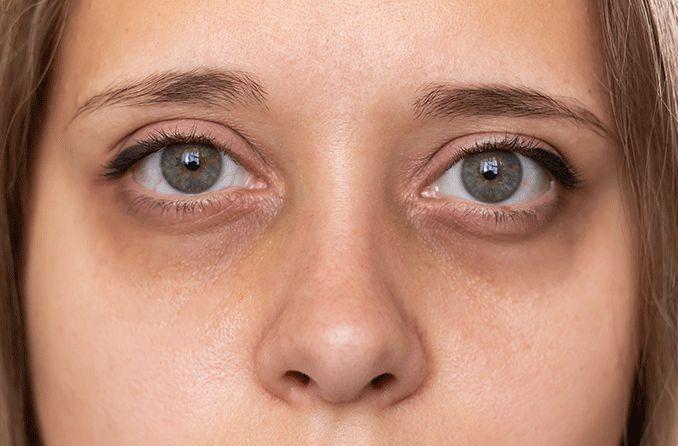 Is Dark Circles Treatment in Dubai Safe for Sensitive Skin