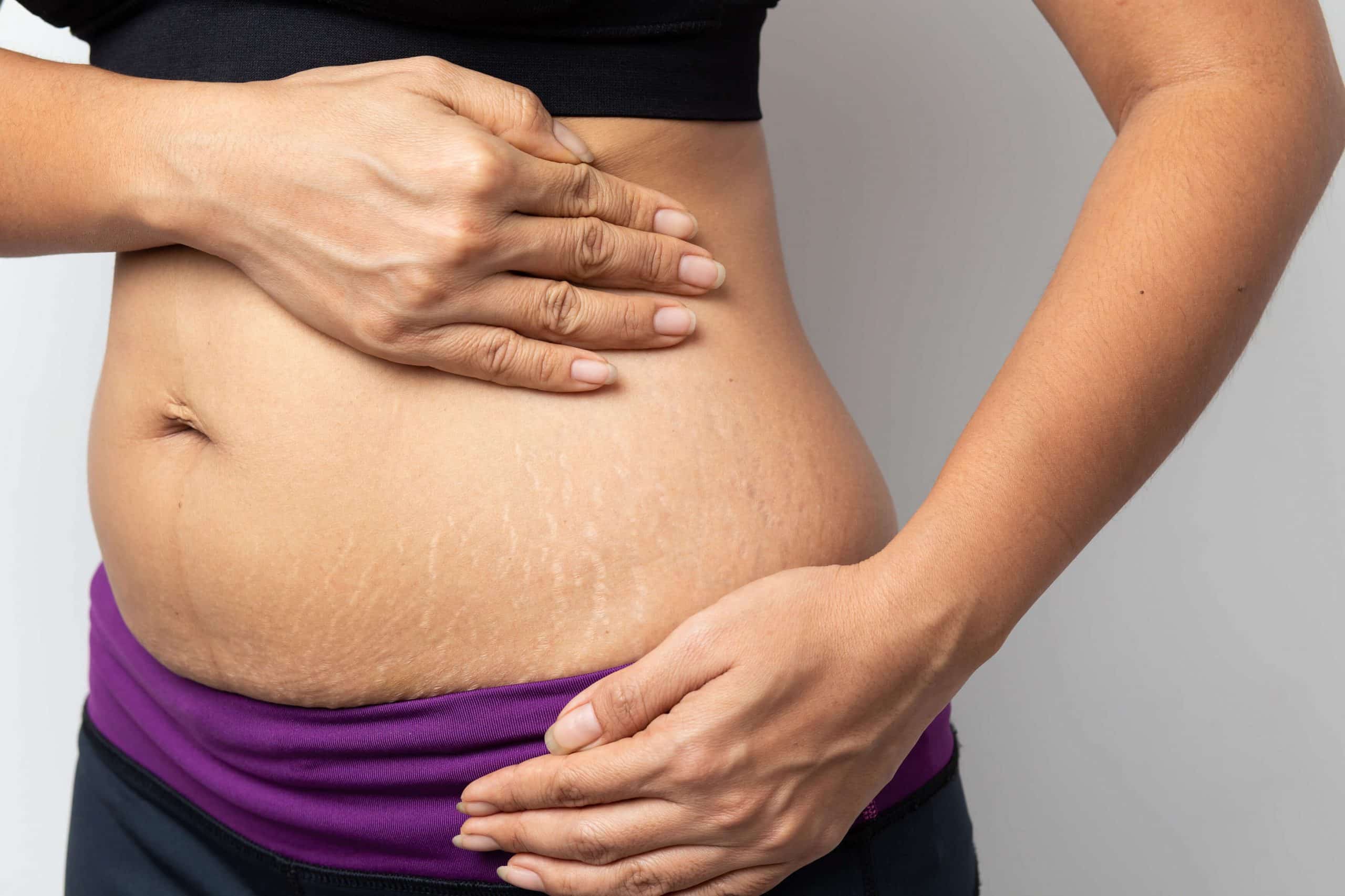 Is Liposuction Effective for Belly Fat in Dubai?