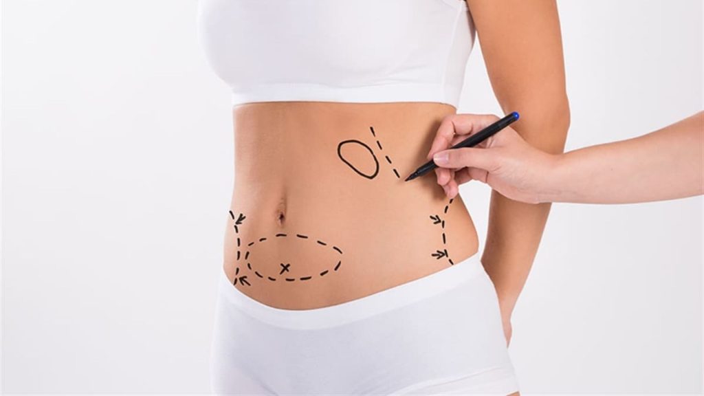 Liposuction Surgery in Dubai