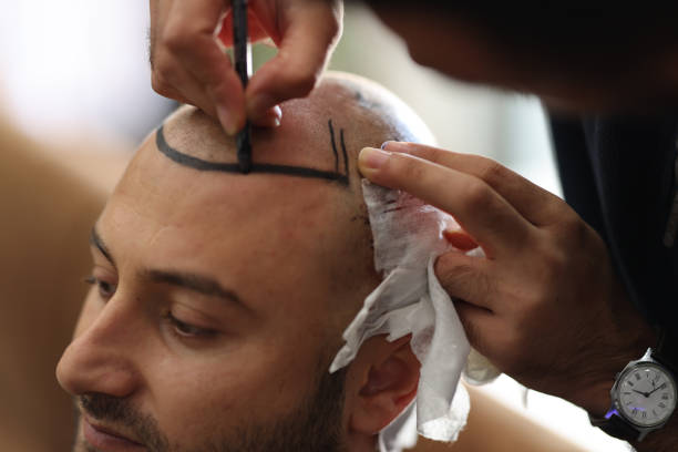 Non-Surgical Solutions with Hybrid Hair Transplants 