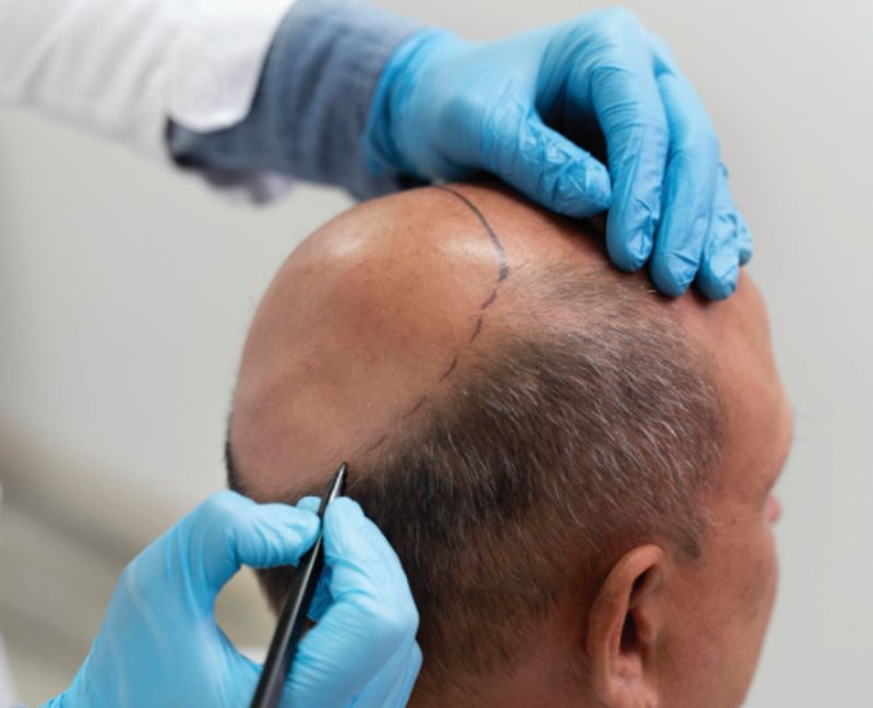 Non-Surgical Solutions with Hybrid Hair Transplants