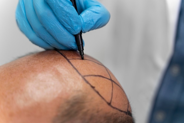 Restore Your Confidence with Scalp Micropigmentation