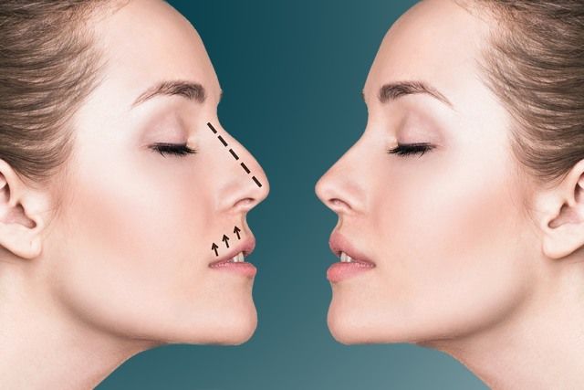 Rhinoplasty Surgery in Dubai