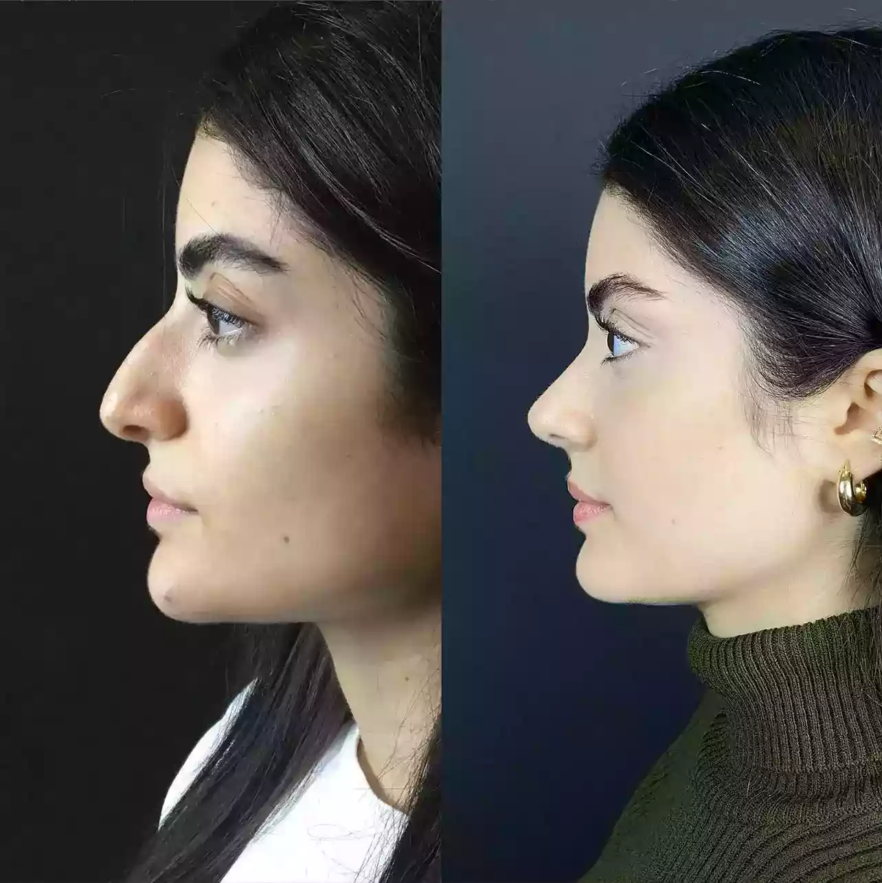 Why Nose Surgery in Dubai Is a Popular Choice