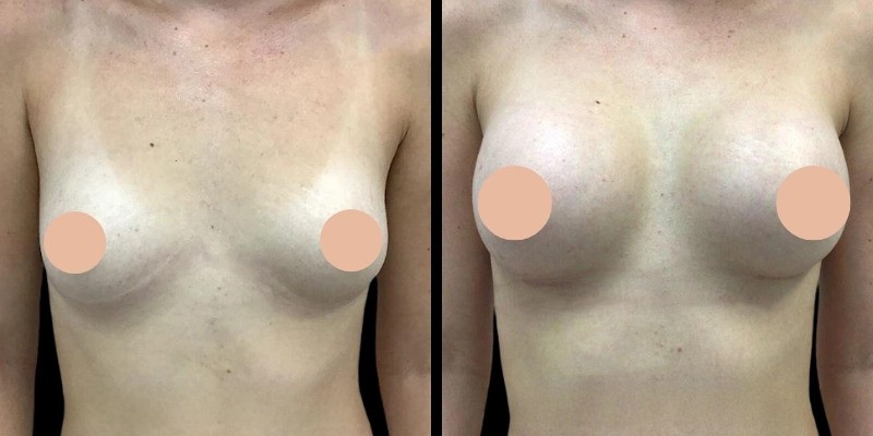 How the Best Breast Augmentation Surgeons in Dubai Personalize Your Procedure