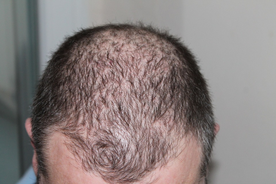 How Do You Achieve Permanent Results from a Hair Transplant?