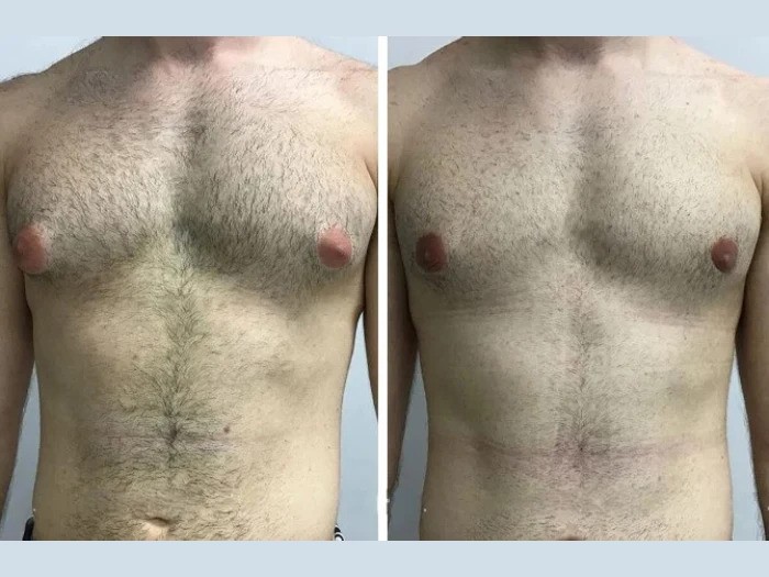 Gynecomastia Surgery in Dubai