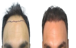 PRP Hair Treatment in Riyadh